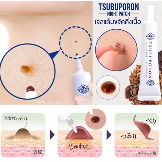 Công dụng của Kem tẩy nốt ruồi Tsubuporon