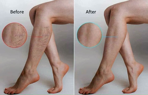 Leg Veins có tốt không